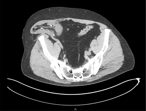Axial view CT: herniation of the transplanted kidney through the right abdominal wall.