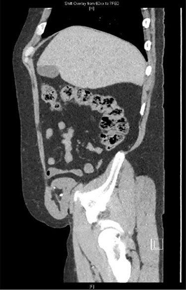 Sagittal view CT: herniation of the transplanted kidney through the right abdominal wall.