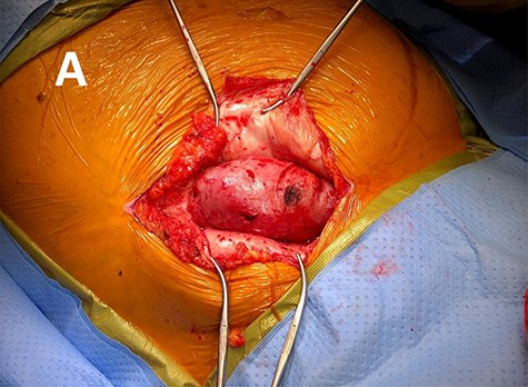 Intra operative photo revealing the herniated transplant kidney through the lateral abdominal wall fascia.