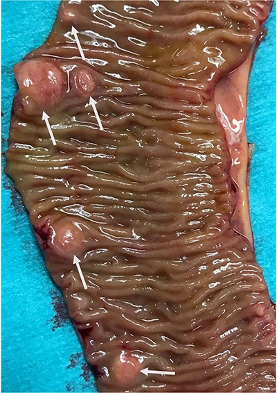 Multiple deposits of the ileal NET (see arrows).