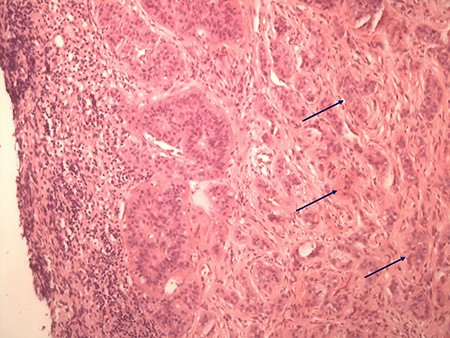 Typical histologic appearance of a well-differentiated neuroendocrine tumour of small bowel (right side, arrows), compared with unaffected ileum (left half of image) on haematoxylin & eosin staining (original magnification ×10).