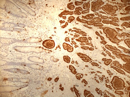 Positive staining of small bowel NET for chromogranin (original magnification ×10).