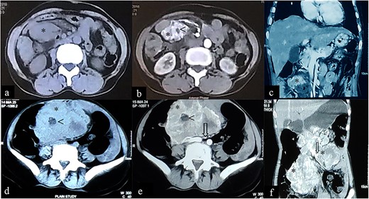 Case 1: CT imaging of extragastrointestinal stromal tumor. (a) Non-contrast axial, (b, c) contrast enhanced axial and coronal reformatted CT images of abdomen demonstrate heterogeneously enhancing confluent mass (*) in peritoneal cavity anterior to the iliac vessels with central area of necrosis (<) peripherally displacing mesenteric vessels (arrow) and bowel. (d–f) Non-contrast axial, contrast enhanced axial and coronal reformatted CT images of abdomen of same patient after 1-year follow-up showing increased interval size of the lesion (*).