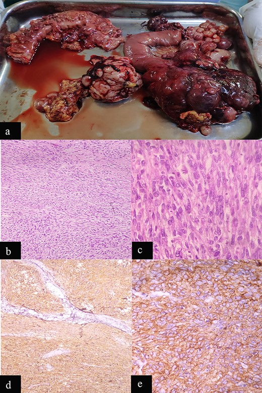 Case 1: macroscopic and microscopic features of extragastrointestinal stromal tumor. (a) Macroscopic appearance of tumor. (b) Low-power view. Tumor cells are arranged in fascicles. H & E stain. Original magnification ×100. (c) High-power view. The tumor cells have scant to moderate amount of cytoplasm. Nuclei are oval to elongated and have coarse nuclear chromatin. Mitosis is also noted (arrow). H & E stain. Original magnification ×400. (d) Low-power view. IHC showing diffuse staining by CD 117. Original magnification ×100. (e) High-power view. IHC showing diffuse cytoplasmic staining by CD 117. Original magnification ×400.