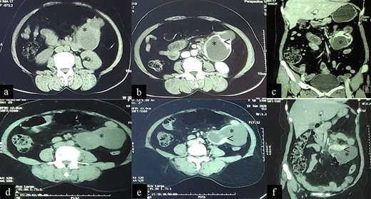 Case 2: CT imaging of Extragastrointestinal stromal tumor. (a) Non-contrast axial; (b, c) contrast enhanced axial and coronal reformatted CT images of abdomen demonstrates intraperitoneal cystic lesion (*) with eccentric enhancing solid component (<) abutting kidney and bowel. (d) Non-contrast axial; (e, f) contrast enhanced axial and coronal reformatted CT images of abdomen of same patient after 1-year interval follow up demonstrates increased size of the lesion (*).