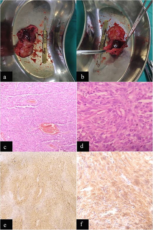 Case 2: macroscopic and microscopic features of extragastrointestinal stromal tumor. (a) Macroscopic appearance of tumor. (b) Macroscopic appearance of tumor showing ruptured cystic component. (b) Low-power view. Tumor cells are arranged in short fascicles. H & E stain. Original magnification ×100. (c) High-power view. The tumor cells have scant to moderate amount of cytoplasm. Nuclei are oval to elongated and have coarse nuclear chromatin. H & E stain. Original magnification ×400. (d) Low-power view. IHC showing diffuse staining by CD 117. Original magnification ×100. (e) High-power view. IHC showing diffuse cytoplasmic staining by CD 117. Original magnification ×400.