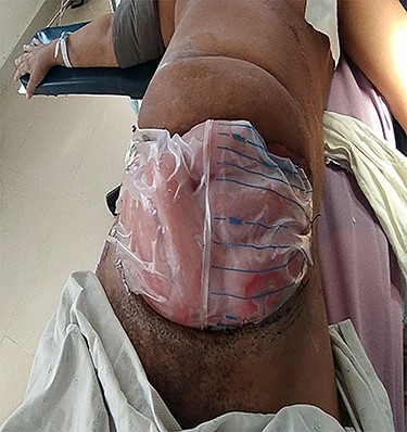 Postoperative open abdominal wound with Bogota dressing.