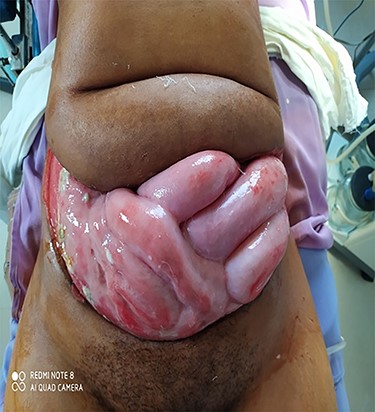 Open abdominal wound with 15 × 30 cm sub-umbilical fascia defect.
