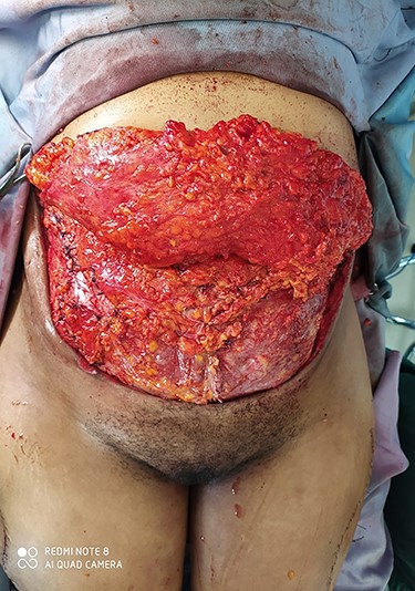 Fascial closure with non vascularized bilateral tensor fascia lata graft.