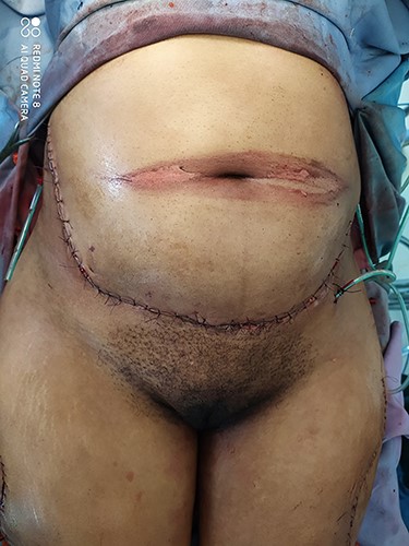Closed abdominal wound.