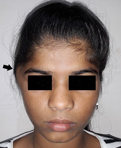 Picture at initial presentation, frontal view, arrow indicates the swelling.