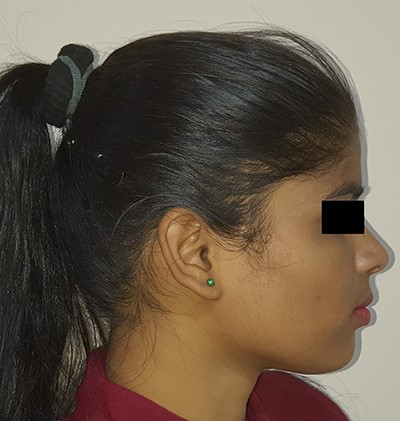 Three-year follow-up, lateral view.