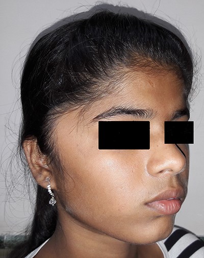 Picture at initial presentation, oblique view.