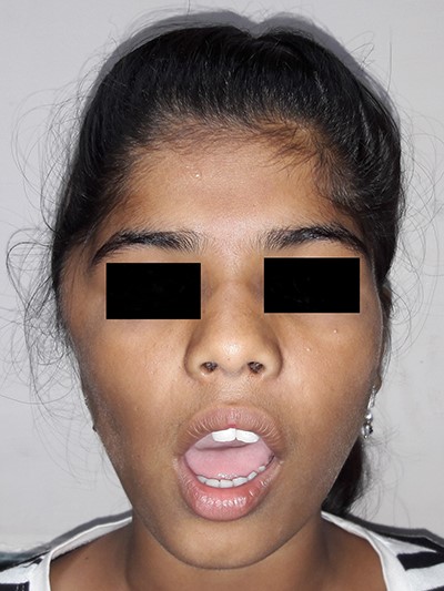 No restriction of mouth opening at initial presentation.