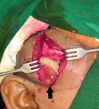 Intraoperative picture, arrow indicates the cysticercus cyst.
