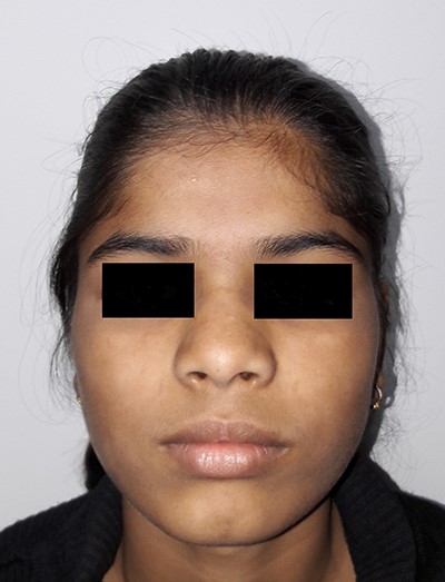 Three months post-surgery, frontal view.