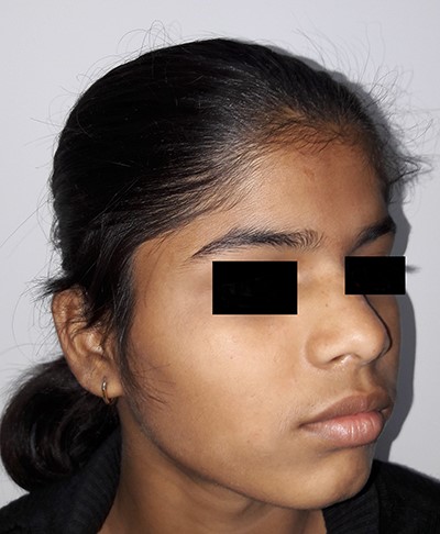 Three months post-surgery, oblique view.