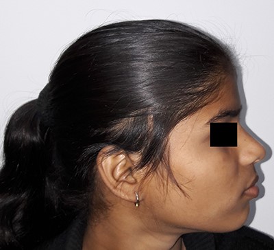 Three months post-surgery, lateral view.