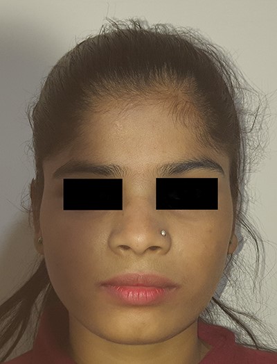 Three-year follow-up, frontal view.