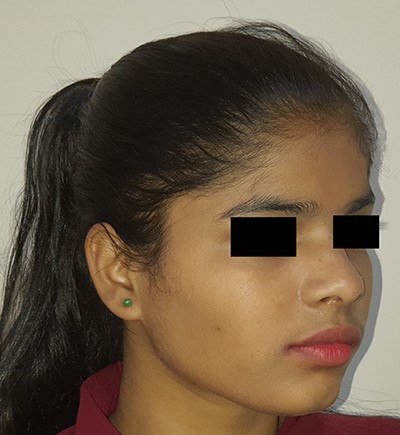 Three-year follow-up, oblique view.