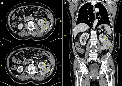 Contrast enhanced thorax, abdomen and pelvis computed tomography scan. a. Axial plane, non-contrast phase. s. Axial plane, venous phase. c. Coronal plane. An eccentric parietal thickening, sized 7.3 × 5 cm. With a cavitated center was observed (a), anteriorly displacing the left kidney with no clear cleavage plane in its inferior third (arrow). A loss of cleavage plane with the posterior-lateral left abdominal wall (b) and the psoas-iliac muscle (c) was also described.