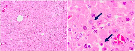 Biopsy: extensive chronic inflammatory reaction with macrophages and Michaelis–Gutmann bodies (arrows).
