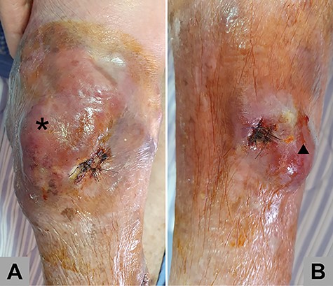 The picture shows (A) the skin lesion located at the anterior aspect of right lower leg (black star sign) after incisional biopsy; (B) the other lesion located at the medial aspect of right lower leg (black triangle) after incisional biopsy.