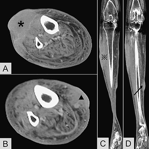 Contrast-enhanced computed tomography revealed (A) transverse view of the anterior lesion of right lower leg (*); (B) transverse view of the medial lesion of right lower leg (▲); (C) coronary view of the anterior lesion (); (D) coronary view of the medial lesion (black arrow).