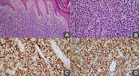 Histopathological examination revealed (A) monotonous, diffuse and non-epidermotropic infiltration of confluent sheets of immunoblasts and centroblasts (H&E, 20×); (B) monotonous and confluent sheets of immunoblasts and centroblasts, many with a striking round cell morphology (H&E, 40×); (C) the large lymphocytes are positive for Bcl-2 immunohistochemical staining (40×); (D) the large lymphocytes are CD20-positive B-cells (40×).