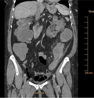 Computed tomography of the abdomen and pelvis showing focal narrowing of the sigmoid colon with proximal colonic dilatation.