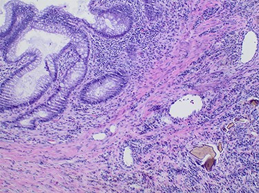 Pathology slide of the sigmoid colon with Sevelamer crystals; colonic mucosa (upper left) with adjacent inflammatory reaction containing entrapped sevelamer crystals (lower right).