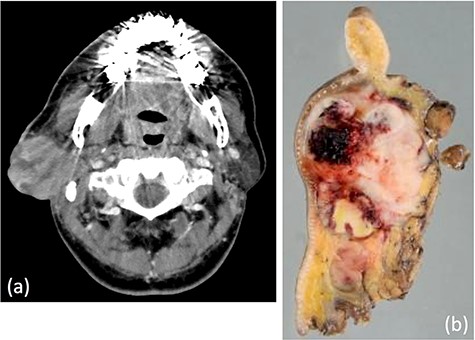(a) Computed tomography revealed a tumor, 5.1 × 5.0 cm in size, within the right parotid gland enhanced by contrast. The tumor had an irregular shape with calcifications, low-density area and the boundary between the tumor and surrounding tissues was indistinct. (b) Macroscopically, the cut surface of the tumor was yellow–white with hemorrhage and necrosis. The tumor boundary was ill-defined.