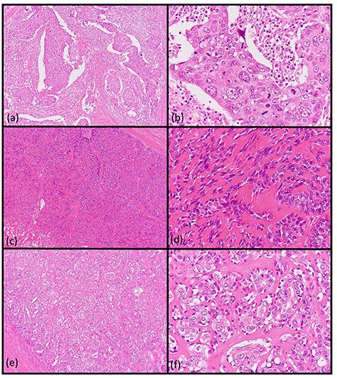 Histopathologic findings of the parotid tumor. (a and b: hematoxylin and eosin staining, ×40 and ×400) The cell type was atypical with abundant granular eosinophilic cytoplasm, large nuclei with coarse chromatin and prominent nucleoli. The cells were proliferative and invasive with duct-like, glandular and solid patterns. (c and d: hematoxylin and eosin staining, ×40 and ×400) The cell type was an atypical spindle-to-epithelioid cell with clear cytoplasm that was proliferative and invasive with trabecular, tubular and solid patterns. (e and f: hematoxylin and eosin staining, ×40 and ×400) The cell type was an atypical duct-like structure comprised of two distinct cell layers. The inner layer consisted of cuboidal cells with eosinophilic cytoplasm and round enlarged nuclei and the outer layer consisted of cells with clear cytoplasm and oval nuclei.