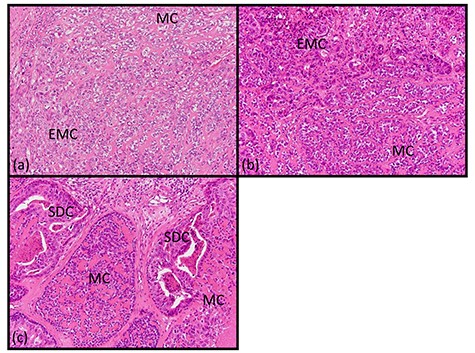Histopathologic findings of transfer area. (a–c: hematoxylin and eosin staining, ×200) The tumor cells of the salivary duct, myoepithelial and EMC appeared to be a mixture with reciprocal transfer in the same area.