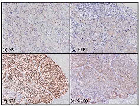 Immunohistochemical findings. Most of the cells of the SDC were positive for AR (a, ×200) and HER2 (b, ×200). Most of the cells of the myoepithelial carcinoma were positive for p63 (c, ×200) and S-100 (d, ×200).