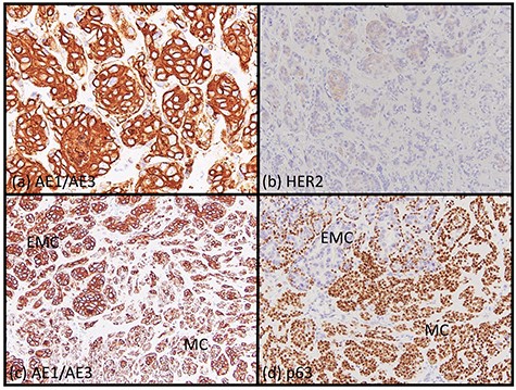 Immunohistochemical findings. Most of EMC inner layer cells were positive for cytokeratin AE1/AE3 (a, ×200) and weakly positive for HER2 (b, ×200). Most of the EMC outer layer cells were weakly positive for cytokeratin AE1/AE3 (a, ×200). In the mixed area, most of the EMC inner layer cells were positive for cytokeratin AE1/AE3 and most of the EMC outer layer cells and MC cells were weakly positive for CK AE1/AE3 (c, ×200). Most of the EMC inner layer cells were negative for p63, and most the EMC outer layer cells and MC cells were positive for p63 (d, ×200).