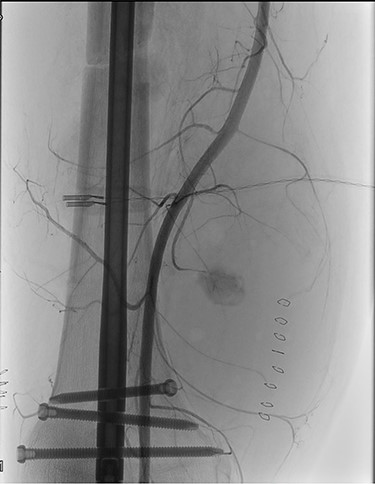 Preoperative angiography showing the pseudo-aneurysm of the right SFA, originating from a small collateral branch of SFA at the distal third of the thigh.
