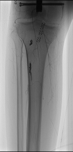 ONYX 34 residuals in the distal popliteal artery and in the tibioperoneal trunk obstructing blood-flow in the right lower limb.