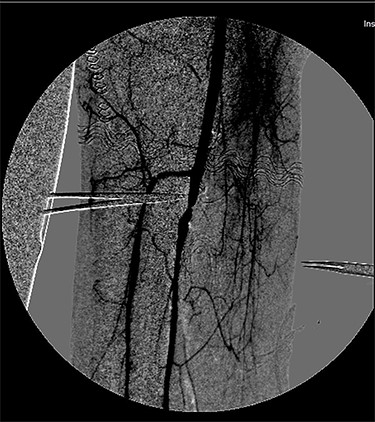 Completion angiography demonstrating patency of the popliteal artery, anterior tibial artery, posterior tibial artery and peroneal artery.