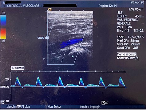 Duplex ultrasound made after 2 months, showing triphasic flow of the right popliteal artery.