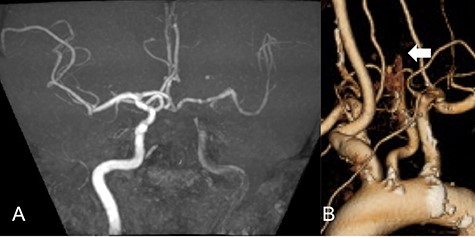 MRA demonstrated left CCA occlusion with collateral flow via anterior and posterior communicating arteries (A). CTA showed left CCA occlusion without aortic dissection (white arrow: B).