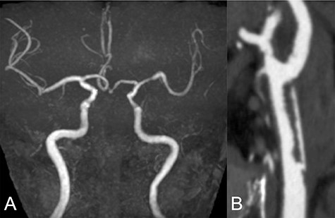 Two weeks after stroke onset, MRA revealed a complete recanalization of the left CCA (A). CTA also showed an irregular vessel wall and a pseudo-lumen located starting at the left CCA extending to the carotid bifurcation (B).