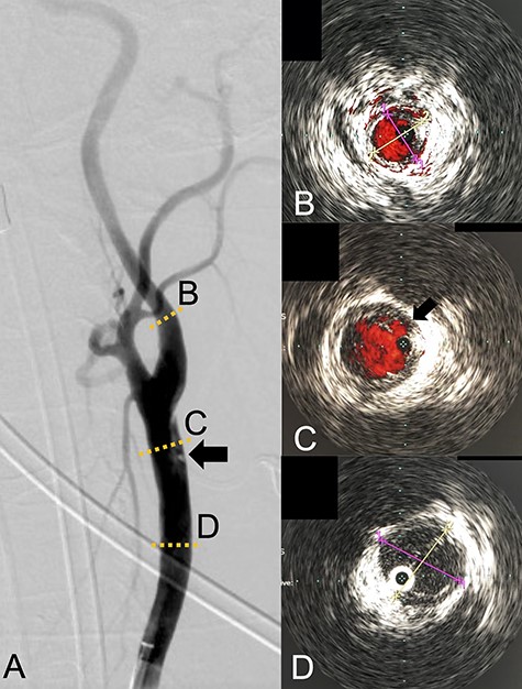 Angiography revealed the dissection starting proximal to the carotid bifurcation (Black arrow: A). IVUS provided the diameters of the ICA and CCA (B and D, respectively). IVUS imaging confirmed the pseudo-lumen of the dissection starting 1-cm proximal to carotid bifurcation (C) and the entry point of the dissection as well (Black arrow: C).