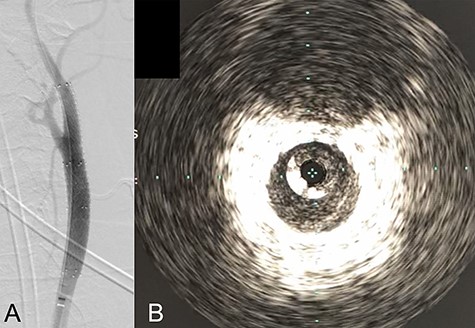 Angiography after stent placement showed favorable patency of the carotid artery with a smooth intra-arterial lumen (A). IVUS performed after stenting confirmed an excellent expansion of the stent to the dissection lesion’s arterial wall with no plaque protruding the stents (B).