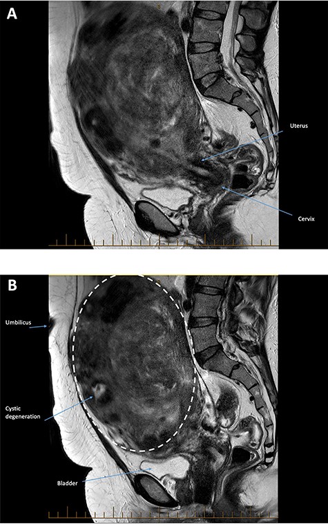 (A and B): Sagittal images from a T2 weighted sequence. Marked enlargement of the uterus secondary to fibroids. The largest fibroid arises at the uterine fundus (dotted line) and extends into the upper abdomen above the level of the umbilicus. It contains areas of focal high T2 signal reflecting cystic degeneration. No malignant or aggressive features are present.