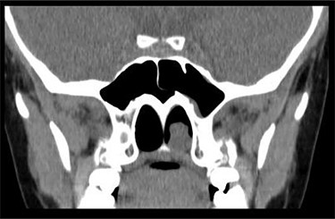 CT scan—coronal cut showing a homogenous mass occupying the inferior aspect of the left choana.