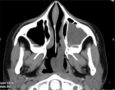 CT scan axial cut showing a large homogenous mass extending across the left nasal cavity.
