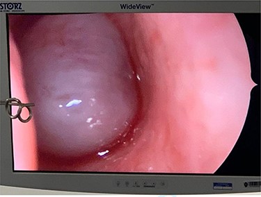 The cystic component of the ACP seen within the left nasal cavity on nasal endoscopy.