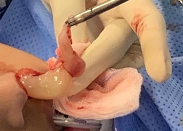 Both the cystic and the solid components of the ACP can be visualized as it has removed from left nasal cavity.