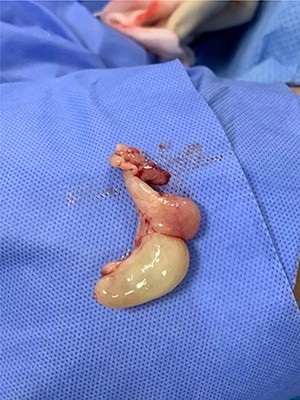 The ACP after removal from the left nasal cavity (measuring 40 × 30 × 15 mm).
